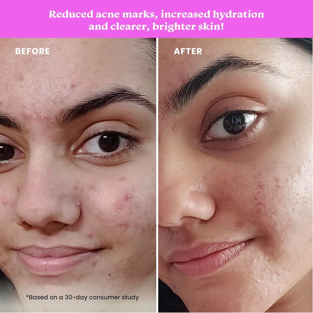 Foxtale 12% Niacinamide Face Serum with Azelaic Acid for Oil Control & Brightening | Reduces Acne, Blemishes & Acne Marks | Brightens & Smoothens Skin | Face Serum for Women & Men | 30 ml - Image 5