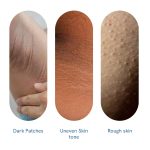 Be Bodywise Pigmentation Cream 100gm | 2.5% Lactic Acid, 2% Urea, Retinol & Kojic Acid | Reduces Tan, Pigmentation & Evens Skin Tone | Treats Dark Patches & Rough Skin on Elbows, Knees, Back of Neck & Thighs | For Daily Use - Image 4