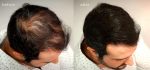 Hair building fiber Black 25 Gms - Image 2