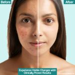 Dr. Reddy's Venusia Acne Control Moisturizer | Pore Minimising & Hydrating | For Oily Skin | Lightens Scars, Reduces Visibility of Pores | Non-comedogenic | 75gm - Image 5
