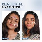 ThriveCo 2% Salicylic Acid Serum for Face | Anti-Acne & Blackhead Removal | Oil Control, Blemish Care & Exfoliating Serum | For Oily & Acne-Prone Skin | 30ml - Image 4